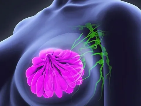 5 dấu hiệu ung thư vú dễ nhận biết nhưng nhiều người bỏ qua: Cẩn thận di căn xa