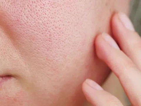 Vì sao lỗ chân lông to và cách chăm sóc da phù hợp cho từng nguyên nhân