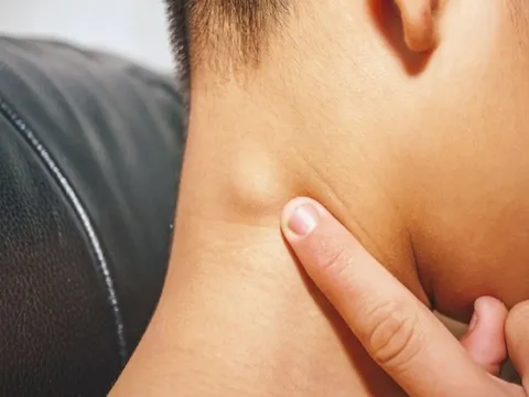 5 dấu hiệu dễ nhận biết nhất của ung thư tuyến giáp