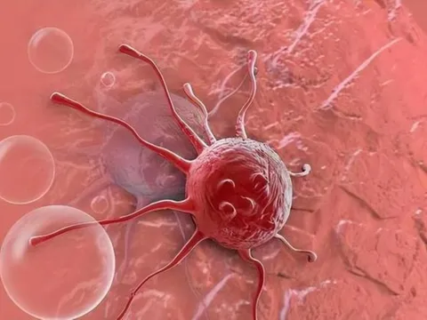 3 căn bệnh ung thư này tiến triển với tốc độ đáng báo động, cách phát hiện sớm