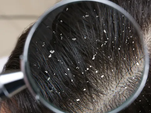 3 Bước chăm sóc tóc giúp da đầu khỏe và tóc mềm mượt hơn