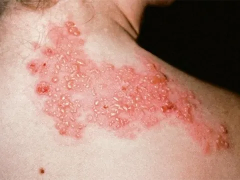 Đây là 3 căn bệnh được y học đánh giá là gây đau đớn nhất