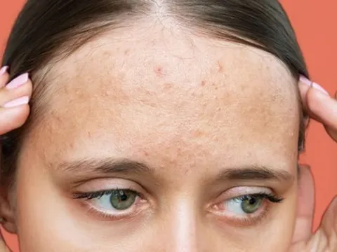 Nhận diện sẹo rỗ và 5 phương pháp cải thiện giúp làn da dần mịn màng hơn