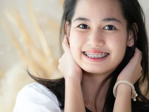 Niềng răng có hết cằm lẹm không? Các phương pháp niềng răng hiệu quả