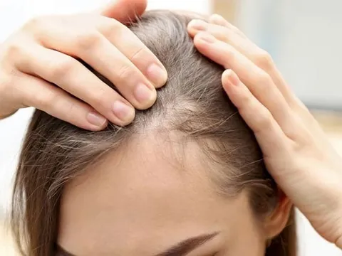3 yếu tố cốt lõi giúp cải thiện tóc thưa, yếu mà không cần phụ thuộc sản phẩm đắt tiền