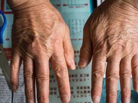 Bàn tay người sống thọ có đặc điểm gì? Nghiên cứu 2 triệu người chứng minh sự thật bất ngờ