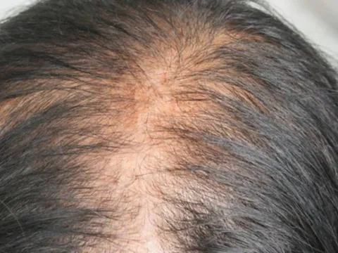 Loại lá chống rụng tóc, kích thích mọc tóc con hiệu quả nhưng đang bị bỏ ph