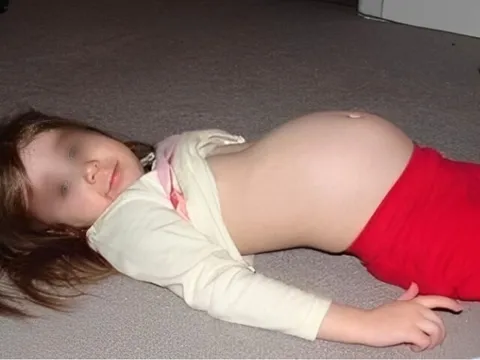 Con gái 12 tuổi đi học về bụng phình to bất thường, kết quả chụp CT tại bệnh viện khiến bố mẹ sợ hãi