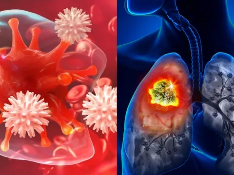 5 loại ung thư phổ biến và nguy hiểm nhất