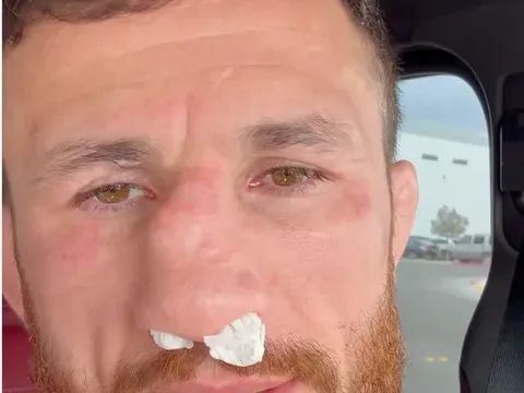 Merab Dvalishvili vỡ mũi: 'Cỗ Máy' từ chối phẫu thuật, chấp nhận 'biến dạng' để theo đuổi ngôi vương UFC