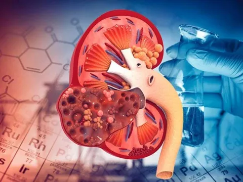 4 dấu hiệu người bị suy thận, buổi tối gặp 1/5 cũng dè chừng