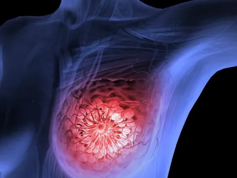 5 dấu hiệu rõ ràng cảnh báo ung thư vú: Đặc biệt dấu hiệu thứ 2 thường xem nhẹ