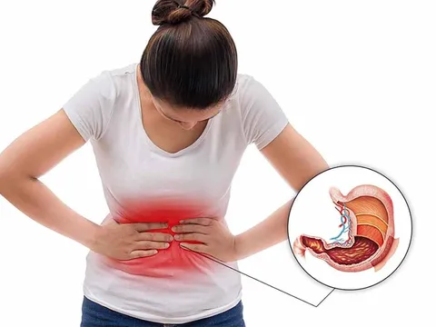 5 biểu hiện của bệnh dạ dày: Có 1 cũng nên đi khám sớm