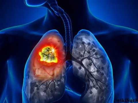 5 dấu hiệu vào buổi tối cảnh báo ung thư: Đặc biệt số 2 rõ ràng mà nhiều người chủ quan