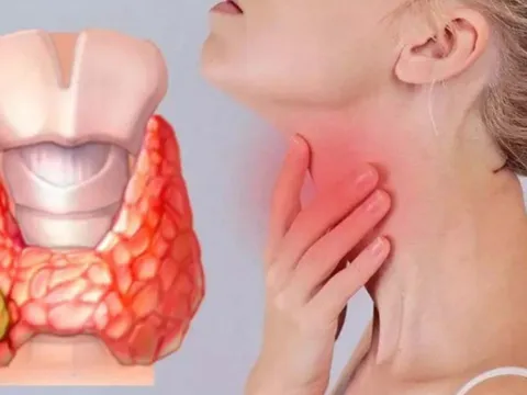5 dấu hiệu ung thư tuyến giáp giai đoạn 1: Biết sớm sẽ kéo dài sự sống