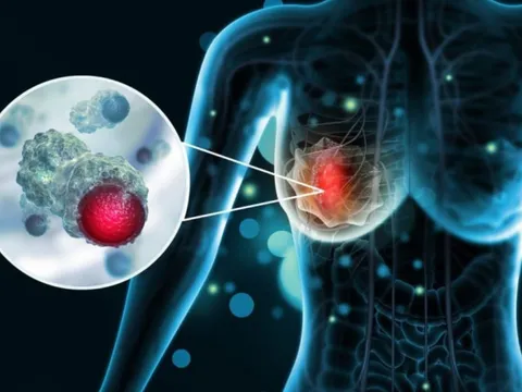 5 dấu hiệu ung thư vú giai đoạn 1: Phát hiện sớm có thể kéo dài sự sống