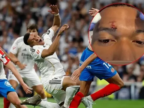 Mbappe phải khâu lông mày trước thềm đại chiến Bayern