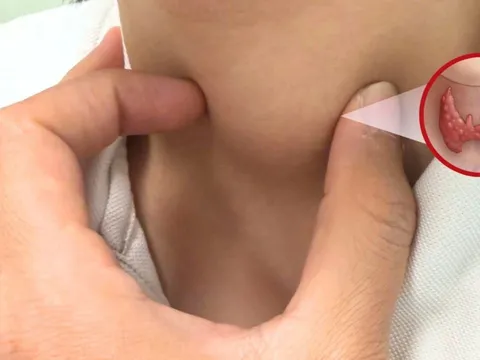 5 nhóm người có nguy cơ cao bị ung thư tuyến giáp