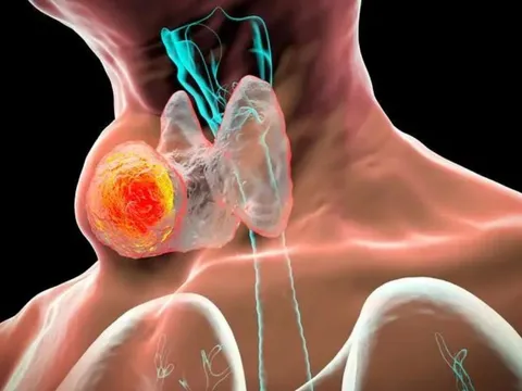 5 dấu hiệu ung thư tuyến giáp giai đoạn cuối: Đặc biệt dấu hiệu đầu tiên
