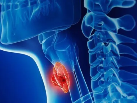 7 dấu hiệu cảnh báo ung thư tuyến giáp giai đoạn 1: Biết sớm có thể chữa khỏi hoàn toàn