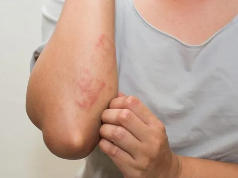 Thiếu nữ tổn thương nhiều vùng cơ thể vì loại vật nuôi quen thuộc, bác sĩ cảnh báo nguy cơ khi thời tiết nắng nóng