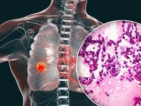 Cảnh báo ung thư phổi gia tăng: Bác sĩ khuyên tránh 4 loại thực phẩm để lâu trong tủ lạnh