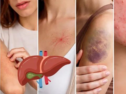 Da xuất hiện 5 dấu hiệu này, đừng chủ quan: Gan có thể đang “kêu cứu”