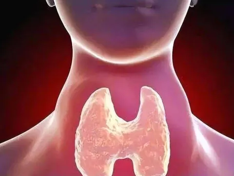 Không được ăn thịt gà khi mắc bệnh tuyến giáp? Cảnh báo 4 nhóm thực phẩm dễ gây dị ứng cần hạn chế