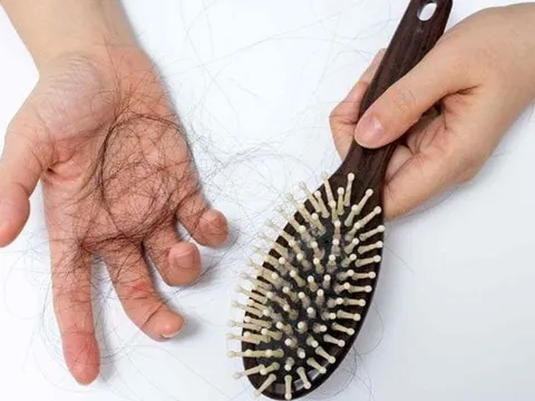 Rụng tóc nhiều: dấu hiệu bình thường hay cảnh báo bất ổn? Cách cải thiện an toàn tại nhà