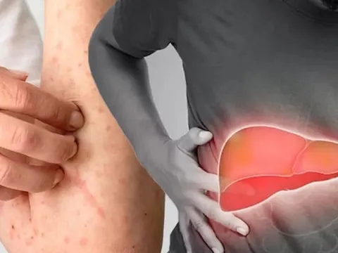 5 biểu hiện sớm của bệnh gan có 1 dấu hiệu cũng nên đi khám sớm