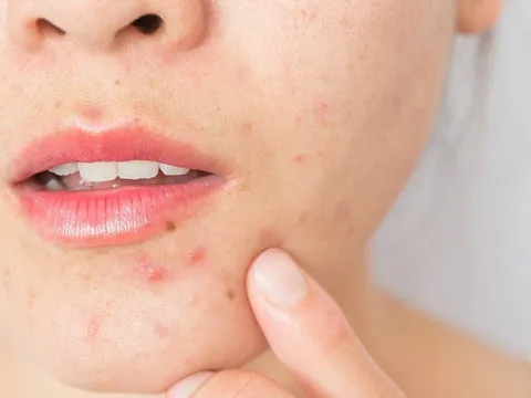 6 sai lầm khiến mụn kéo dài dai dẳng và cách xử lý đúng để da phục hồi hiệu quả