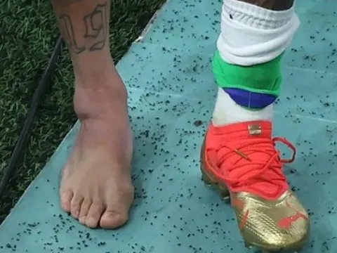 Neymar không quan tâm đến cái chân sưng tấy dữ dội