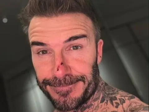 David Beckham bị con gái cắn xước mũi