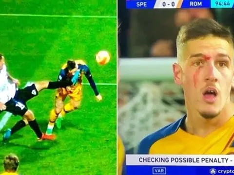 Học trò Mourinho trưng bộ mặt bầm dập sau chiến thắng nghẹt thở