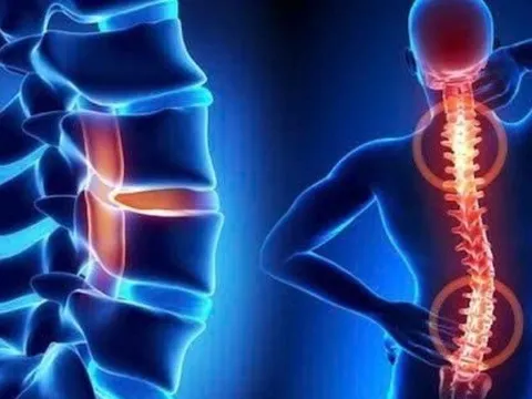 Sáng cứng cổ, chiều mỏi lưng: Khi đau cột sống trở thành vấn đề cần chăm sóc lâu dài