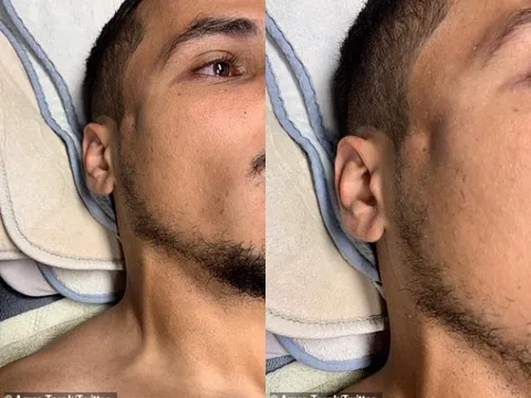 Kinh dị! Ibrahimovic thúc cùi chỏ... gây lõm mặt, vỡ xương đối thủ