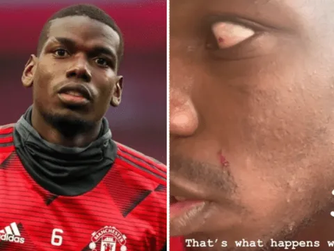 Va chạm trên sân tập, Pogba "trầy da tróc vẩy" trước Lindelof