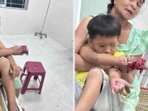 Cháu bé bị dập bàn tay nghi do điện thoại nổ khi đang sạc pin