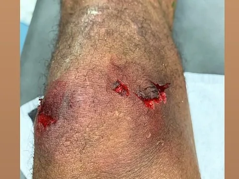 Varane để lộ chấn thương ghê rợn sau trận thua Barca