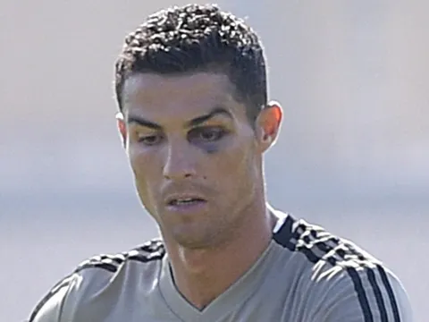 Ronaldo bất ngờ xuất hiện với quầng mắt thâm tím