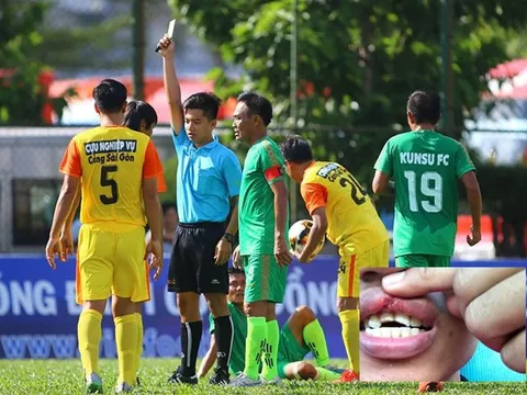 Trọng tài Việt Nam bị húc gãy răng ở giải phong trào