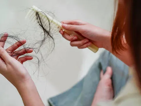 4 thực phẩm gây rụng tóc, ăn càng nhiều tóc càng mỏng