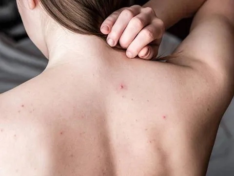 Cải thiện mụn lưng và da sần sùi tại nhà: Routine đơn giản giúp da body mịn màng rõ rệt