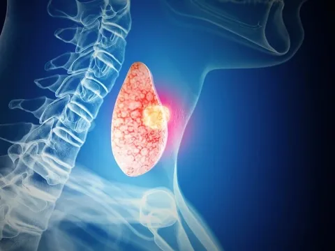 5 dấu hiệu K tuyến giáp mới vào giai đoạn 1: Biết sớm sẽ kéo dài sự sống