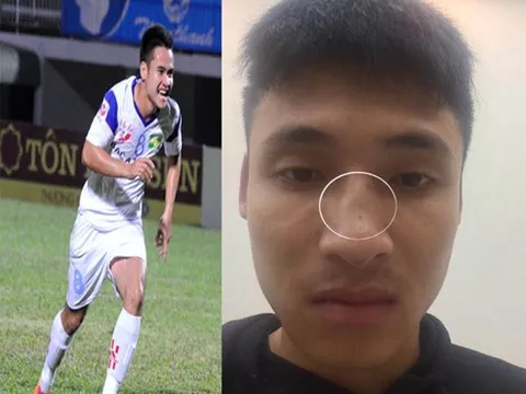 Cầu thủ Đắk Lắk tố bị cựu tiền đạo U23 Việt Nam đấm gãy sống mũi