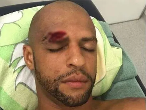 ‘Thùng rác vàng’ Brazil dính chấn thương kinh dị