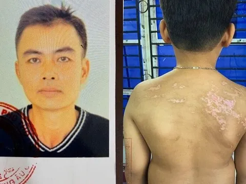 Khởi tố người cha bạo hành con ruột gây thương tích 36% gây phẫn nộ