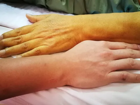 5 dấu hiệu cảnh báo gan thận đang "kêu cứu", số 1 bệnh đã chuyển nặng