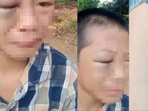 Đang xác minh vụ bé trai 12 tuổi, nghi bị bố và mẹ kế gây thương tích