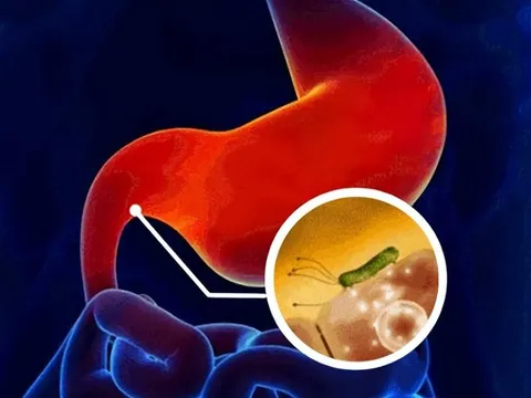 5 dấu hiệu cảnh báo sớm về K dạ dày, biết sớm tăng tỷ lệ sống lên hơn 90%